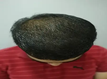 Follicular Stem Cell Therapy FSCT after hair transplant result
