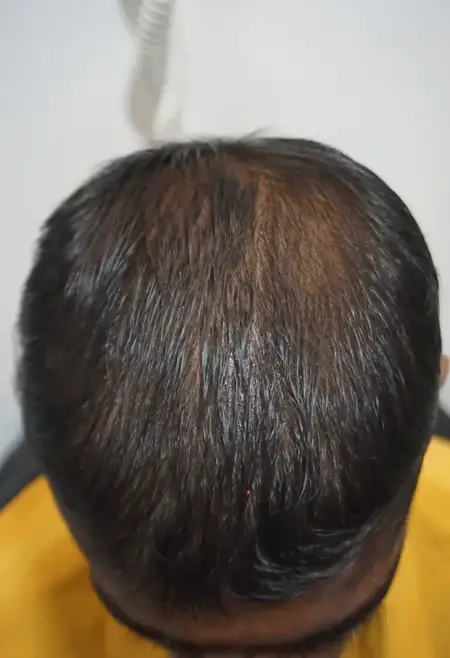 Alopecia hair loss treatment after result at Radiance Clinic