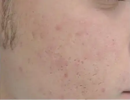 Scar revision skin treatment after result at Radiance Clinic