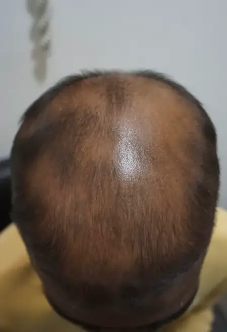 Alopecia hair loss treatment before result at Radiance Clinic