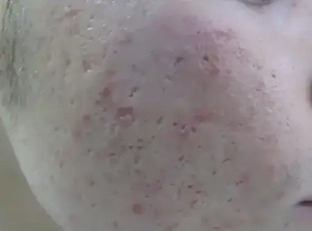 Scar revision skin treatment before result at Radiance Clinic