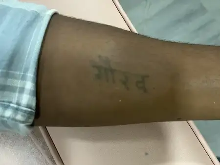 Tattoo removal treatment before result at Radiance Clinic