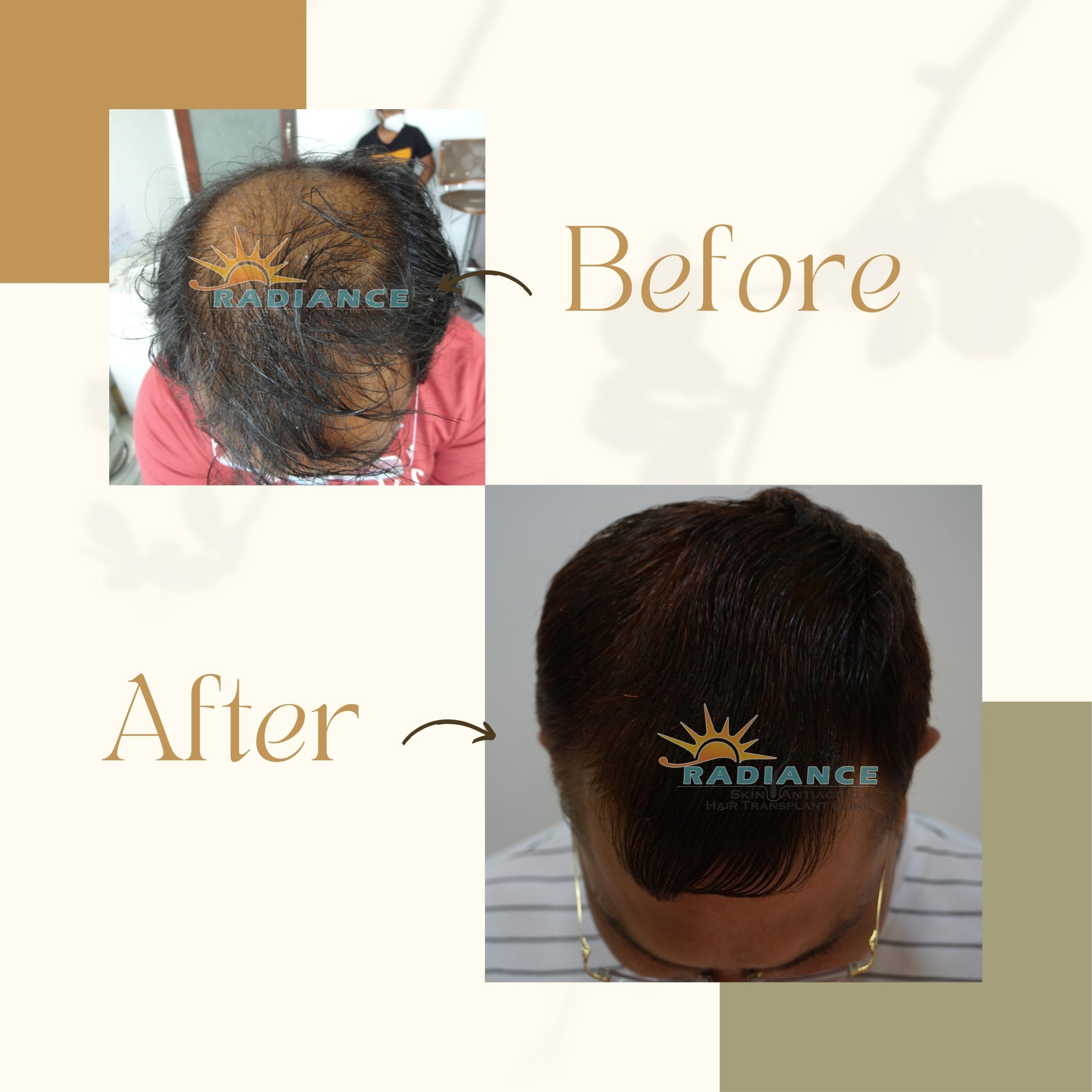 Hair Transplant In Amravati - Radiance Skin Antiaging & Hair Transplant  Clinic